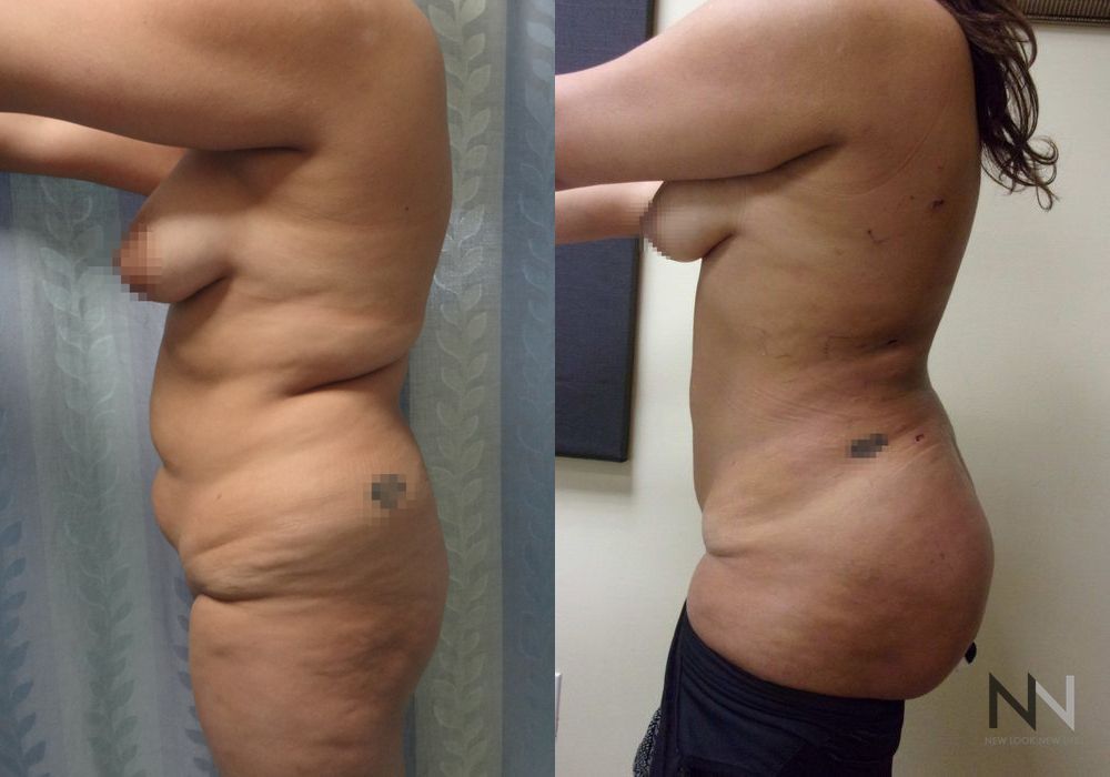 Brazilian Butt Lift - Thumbnail 2