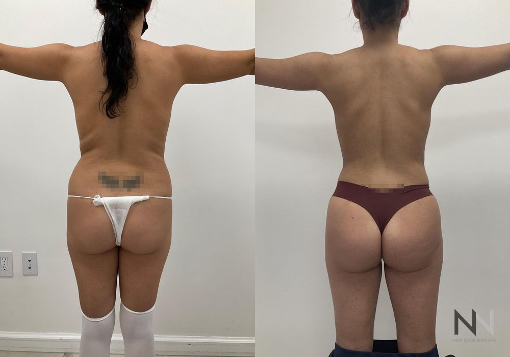 Brazilian Butt Lift - Thumbnail 3