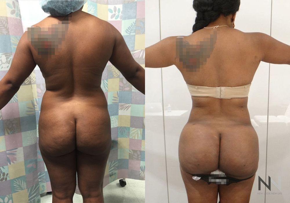 Brazilian Butt Lift - Thumbnail 2