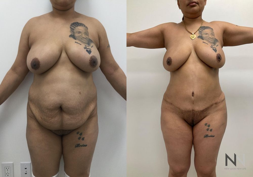 Brazilian Butt Lift - Case 1980