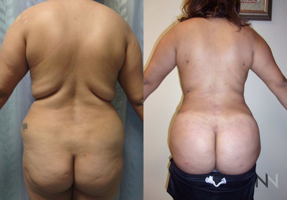 Brazilian Butt Lift - Case 1800