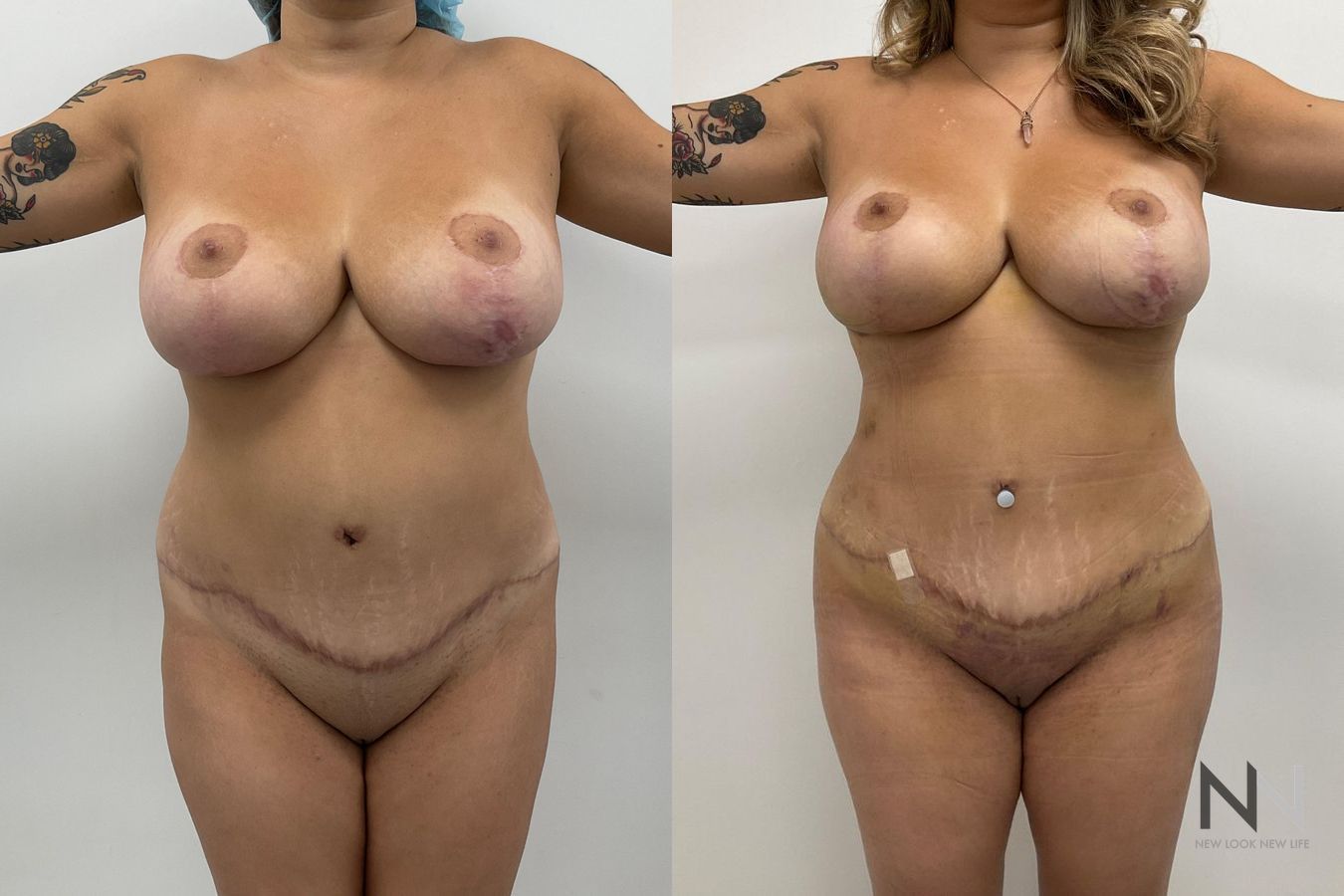 Before and after Brazilian Butt Lift six months results - Angle 2
