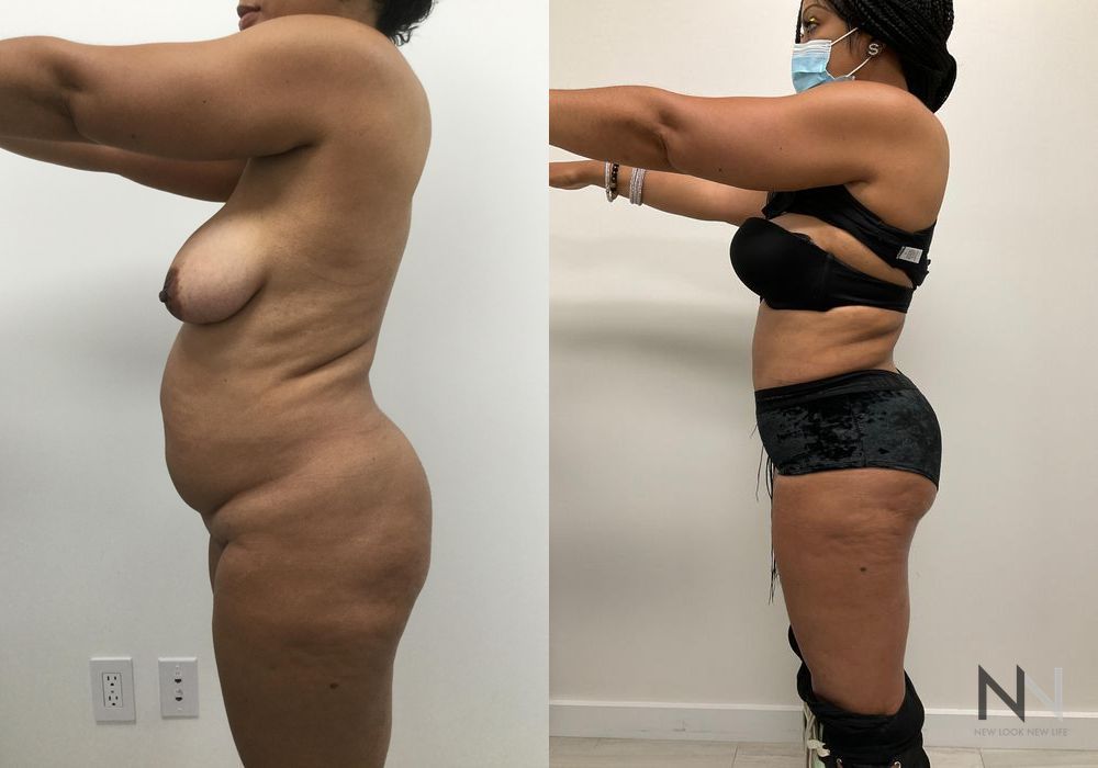 Brazilian Butt Lift - Thumbnail 2