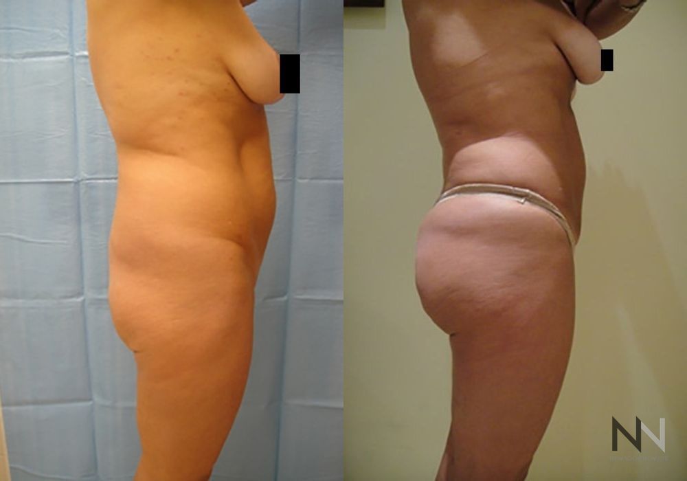 Brazilian Butt Lift - Thumbnail 2