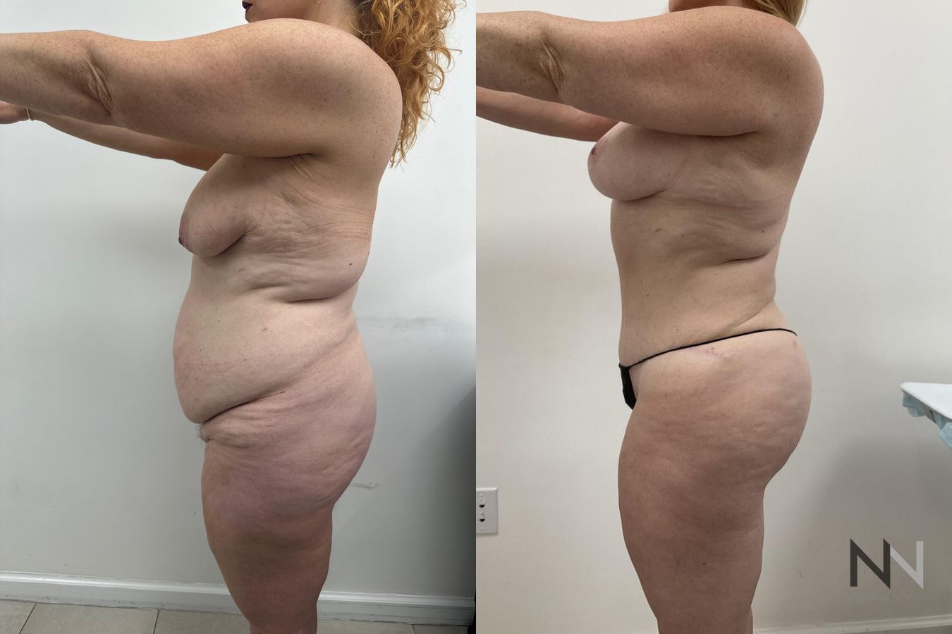 Before and after Breast Lift case 21215 - Angle 3