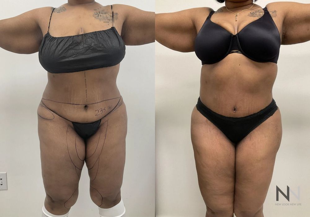 Brazilian Butt Lift - Case 1986