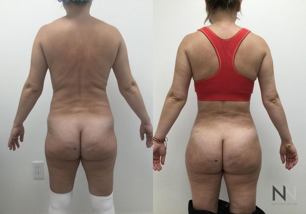 Brazilian Butt Lift - Thumbnail 3