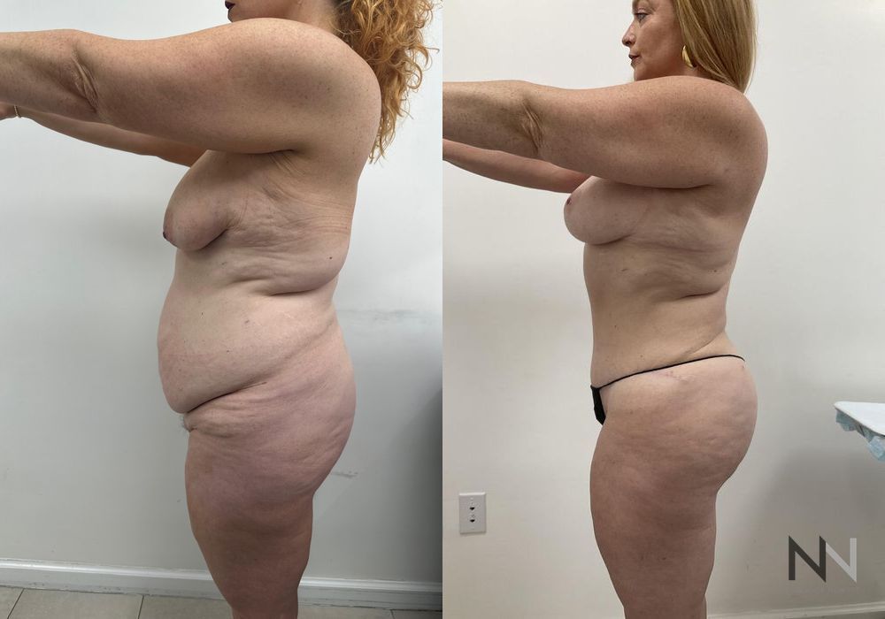 Brazilian Butt Lift - Thumbnail 3