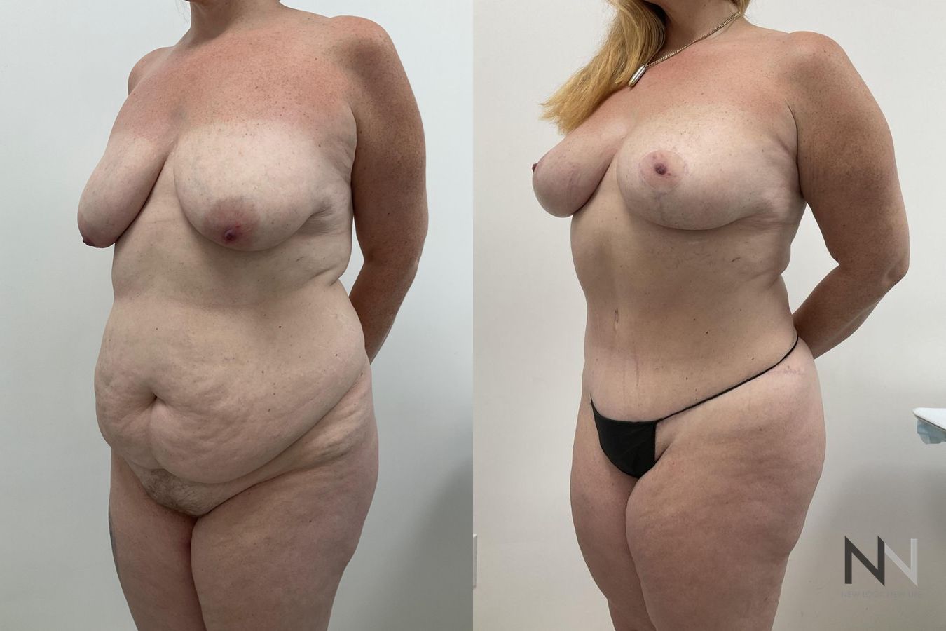 Before and after Breast Lift case 21215 - Angle 2