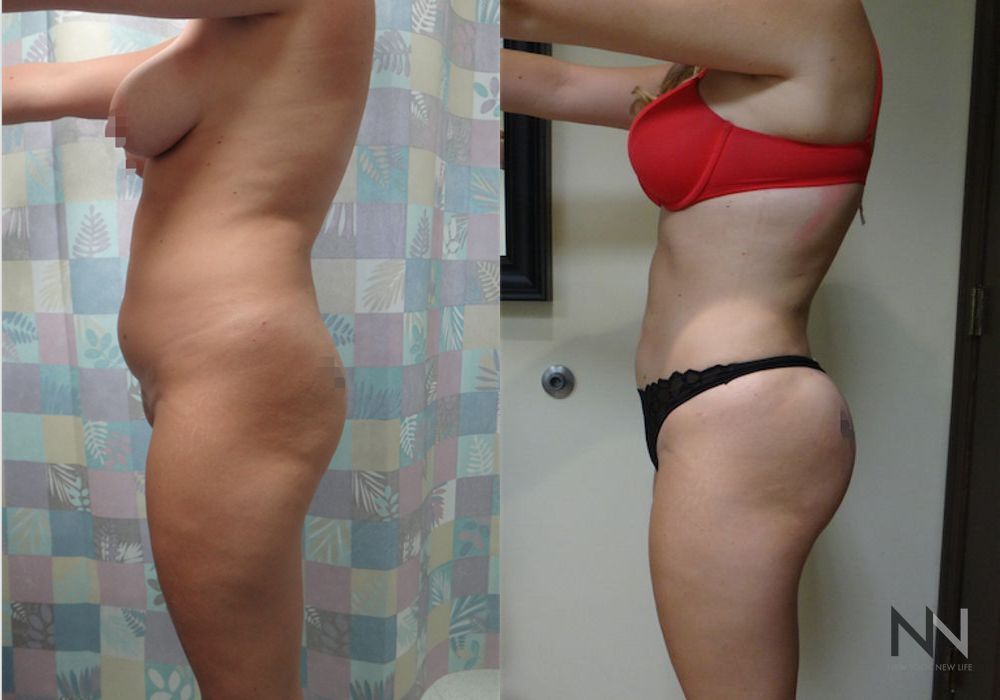 Brazilian Butt Lift - Thumbnail 2