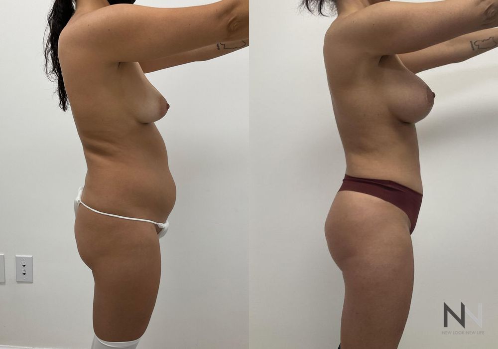 Brazilian Butt Lift - Case 1792