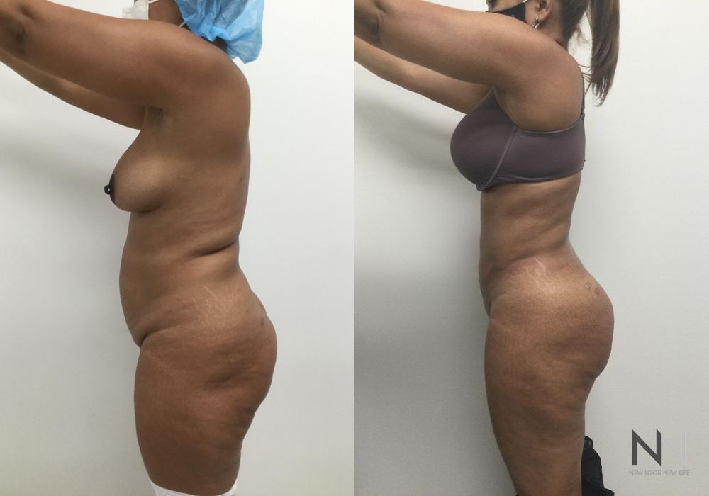 Brazilian Butt Lift - Thumbnail 3