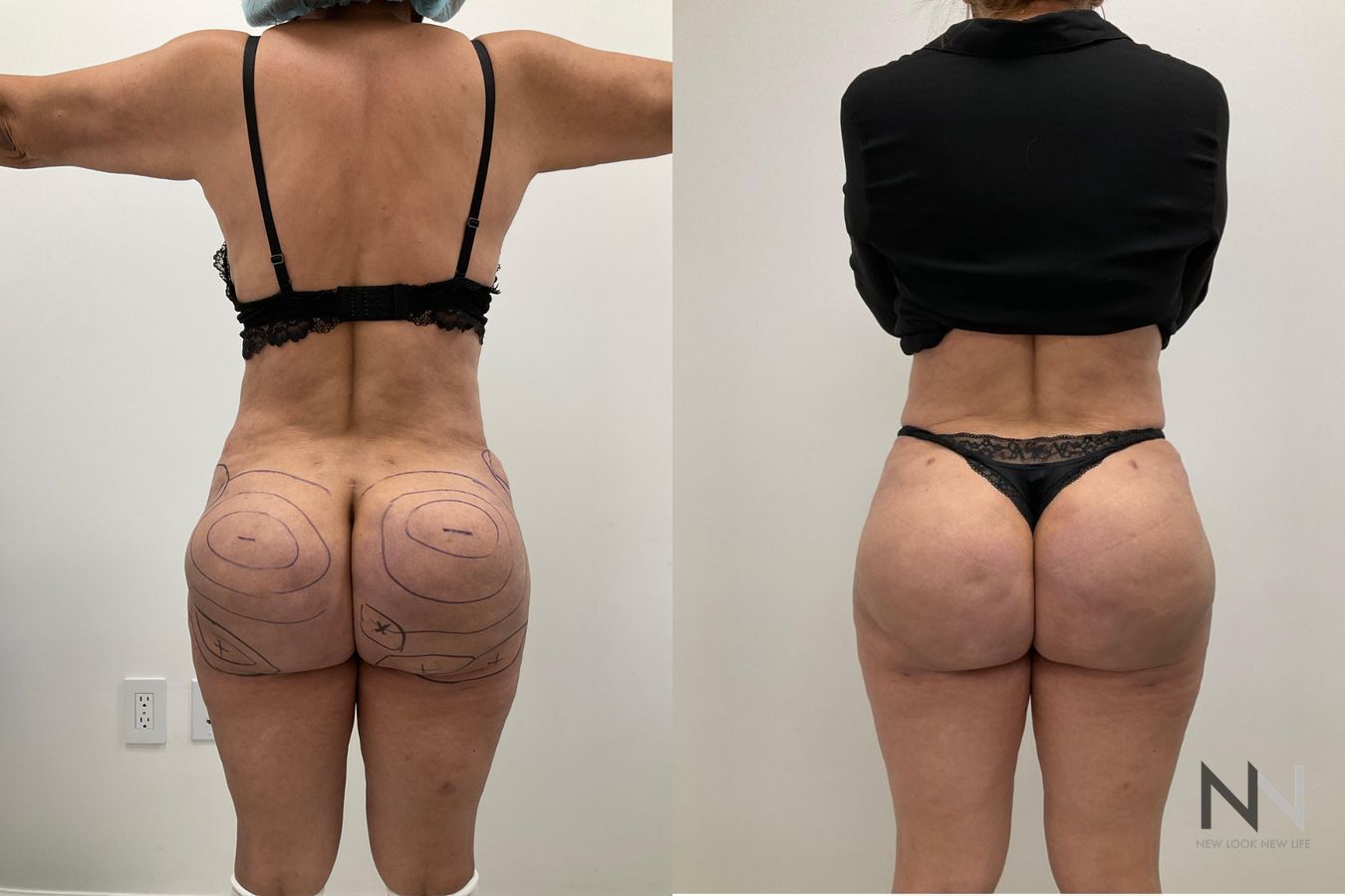 Before and after Brazilian Butt Lift showing enhanced buttock volume and improved projection six months after surgery.