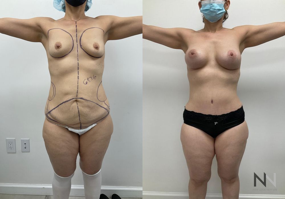 Breast Augmentation - Thumbnail 2