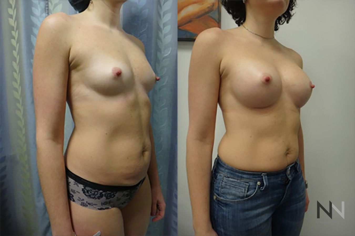Breast augmentation before and after symmetry improvement - Angle 4