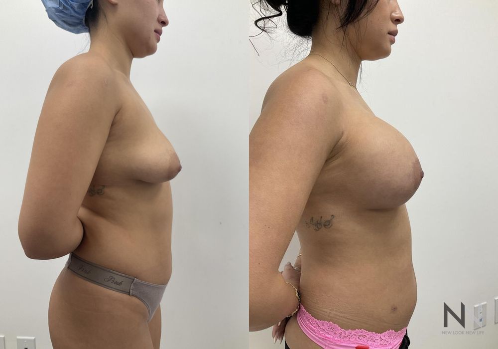 Breast Augmentation - Thumbnail 8