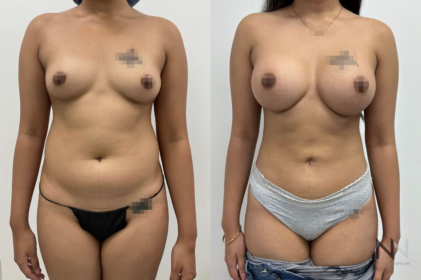 Before-and-after images of Liposuction 360 by Dr. Claudia Kim, showcasing contouring of the abdomen, flanks, back, and underarm areas for a more defined silhouette.