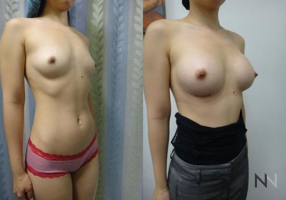 Breast Augmentation - Thumbnail 2