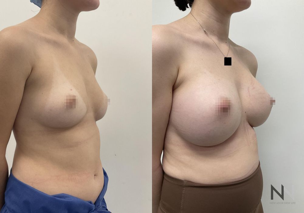 Breast Augmentation - Thumbnail 5