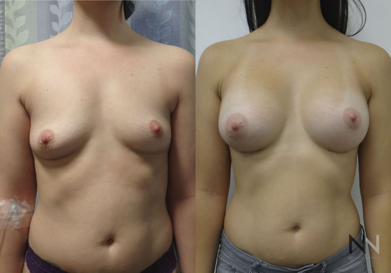Breast augmentation before and after symmetry improvement