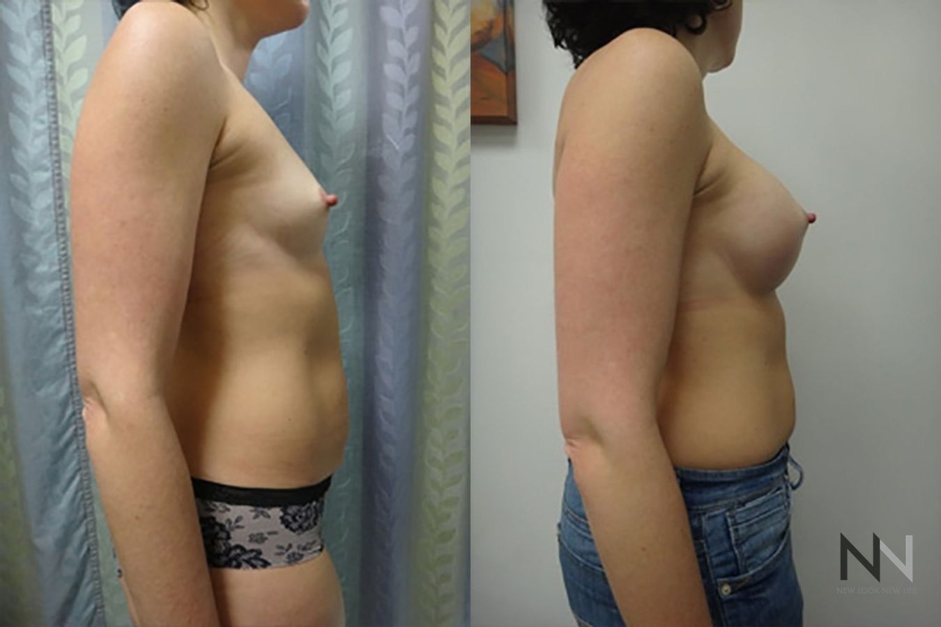 Breast augmentation before and after symmetry improvement - Angle 5