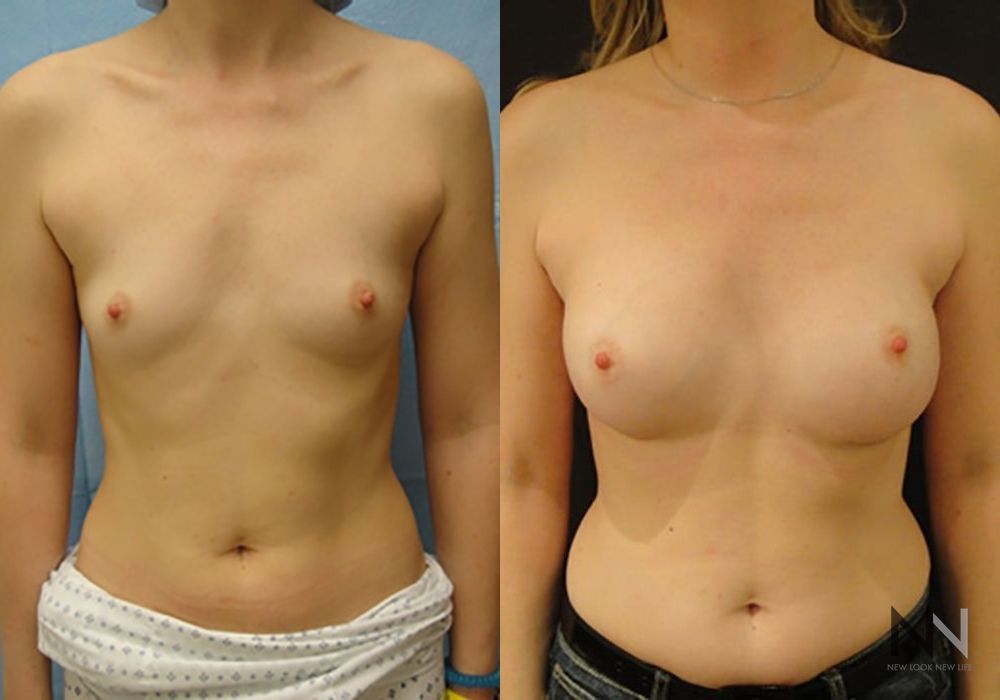 Breast Augmentation - Case 1993