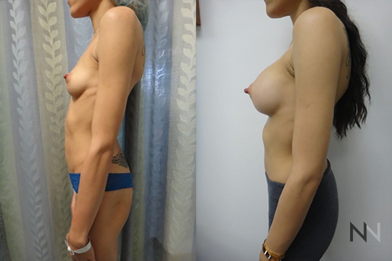 Before and after breast augmentation six months results - Angle 3