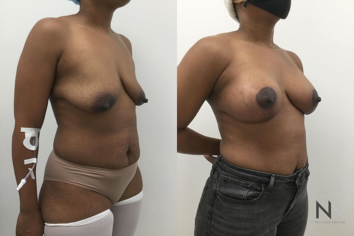 Breast augmentation before and after symmetry improvement