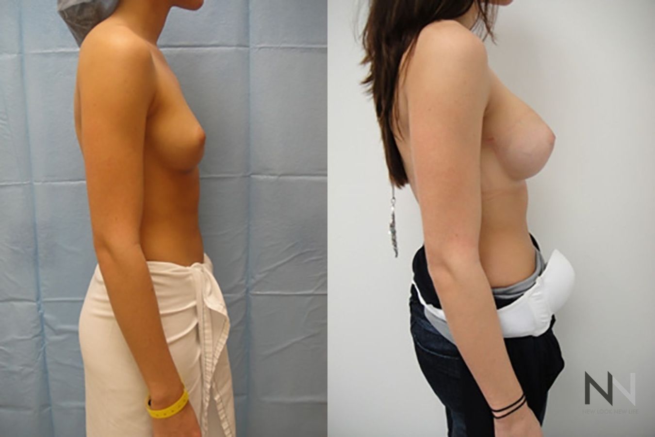Before and after breast augmentation showing increased volume - Angle 5