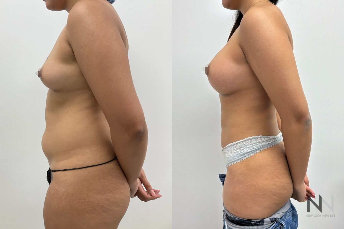 Before-and-after images of Liposuction 360 by Dr. Claudia Kim, showcasing contouring of the abdomen, flanks, back, and underarm areas for a more defined silhouette. - Angle 2