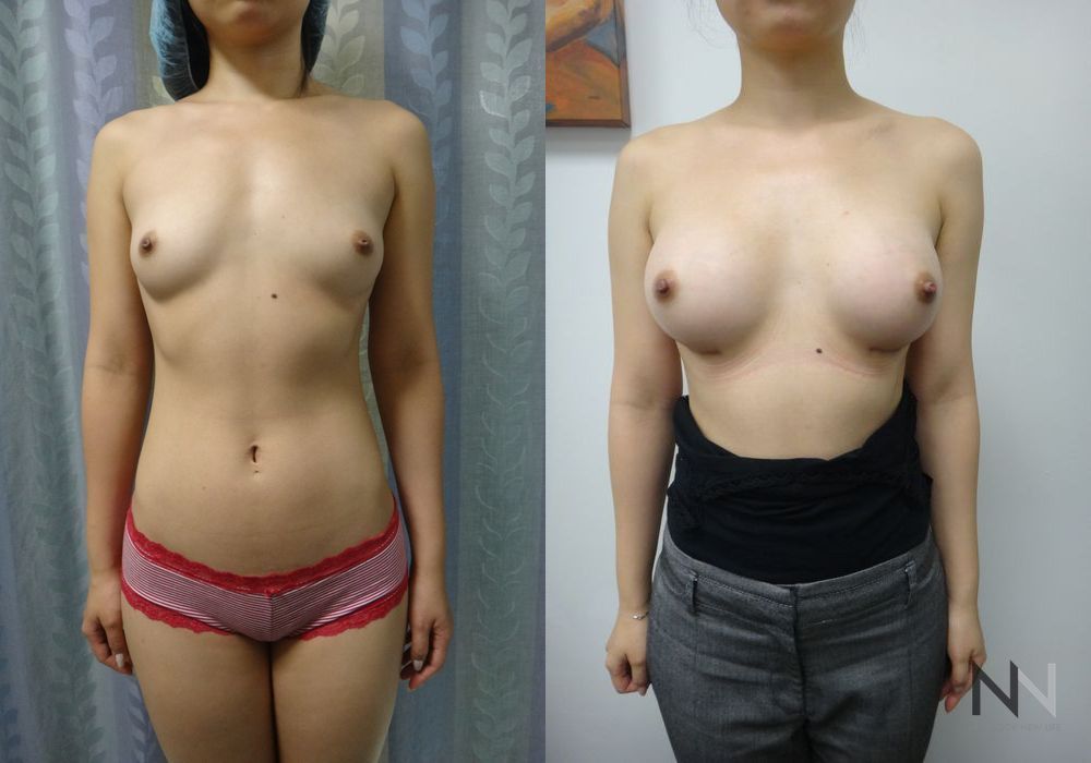 Breast Augmentation - Thumbnail 4