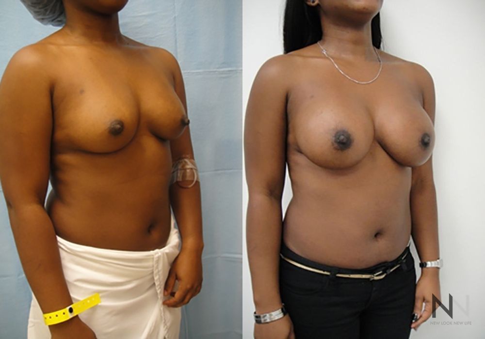 Breast Augmentation - Thumbnail 4
