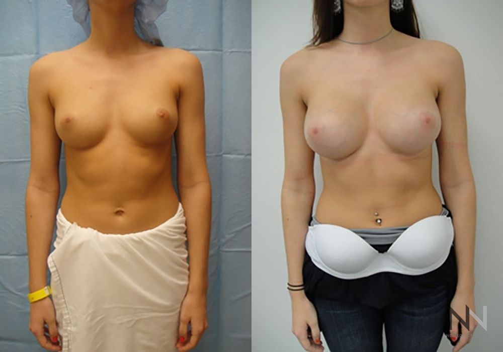 Breast Augmentation - Case 1994