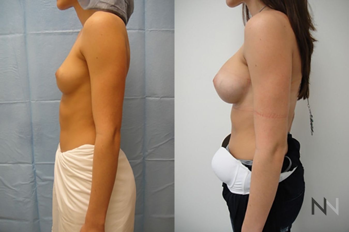 Before and after breast augmentation showing increased volume - Angle 3