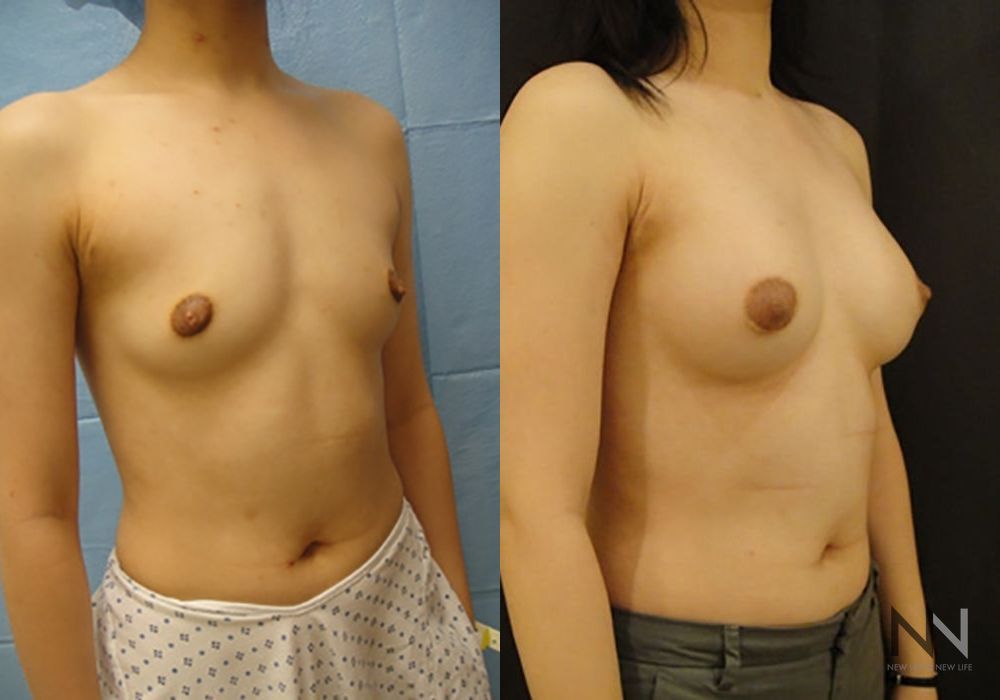Breast Augmentation - Thumbnail 3