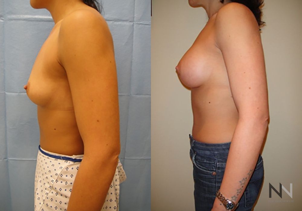 Breast Augmentation - Thumbnail 3