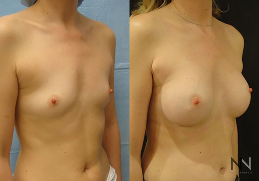 Breast Augmentation - Thumbnail 3