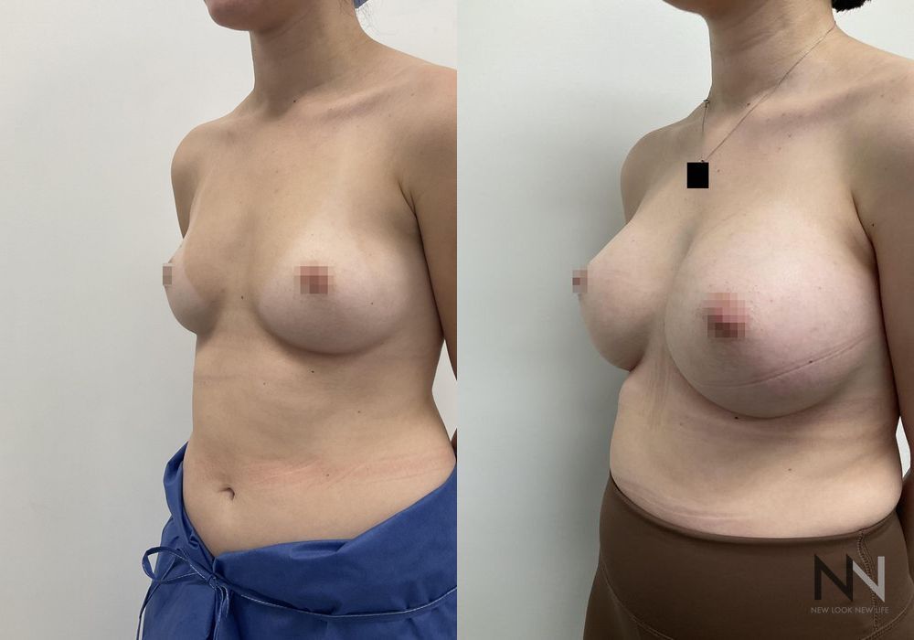 Breast Augmentation - Thumbnail 2