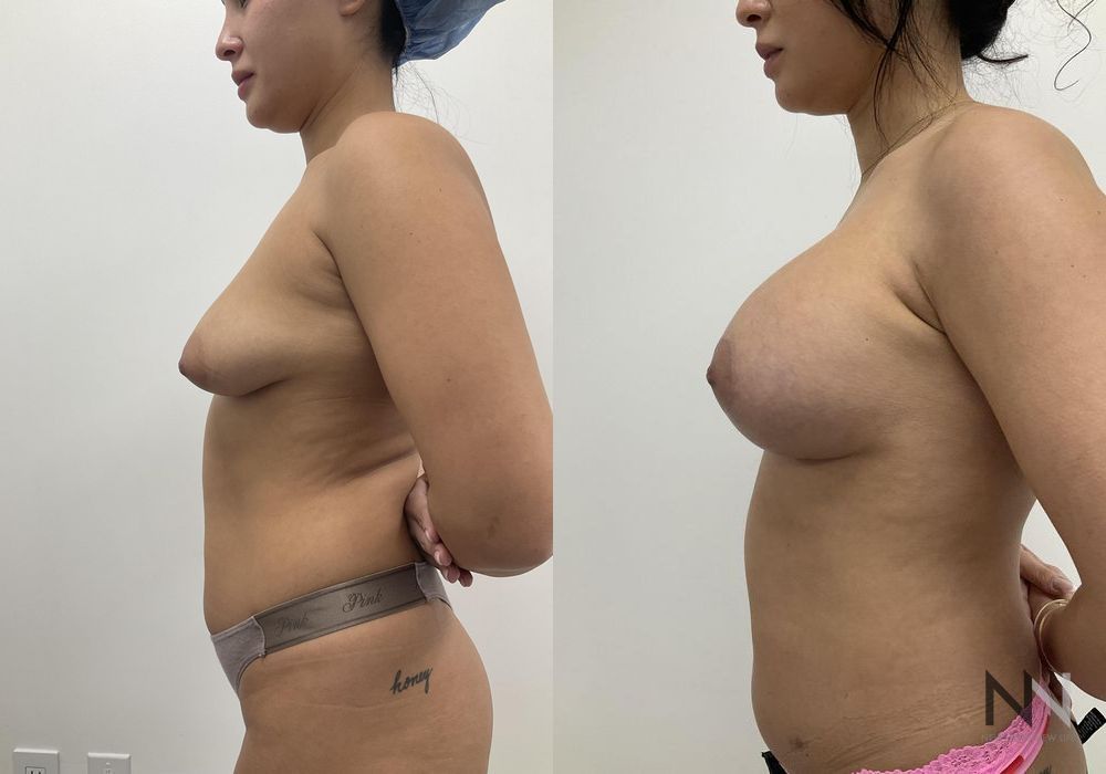 Breast Augmentation - Thumbnail 3