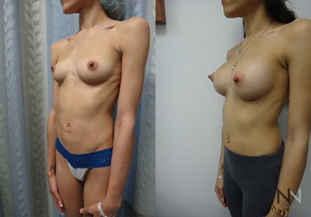 Breast Augmentation - Thumbnail 2