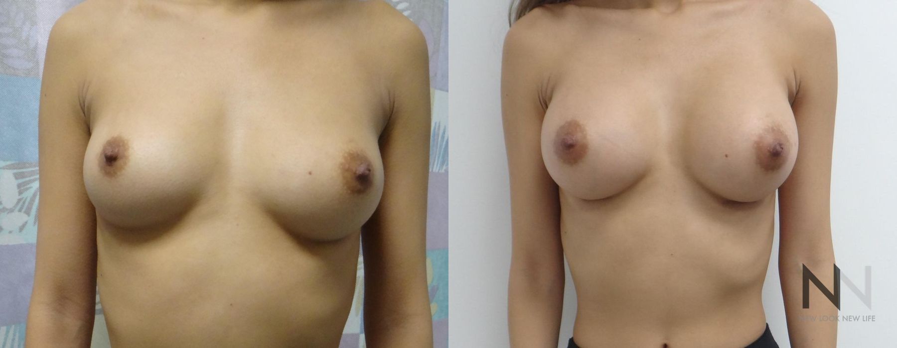 Breast Augmentation - Case 1803