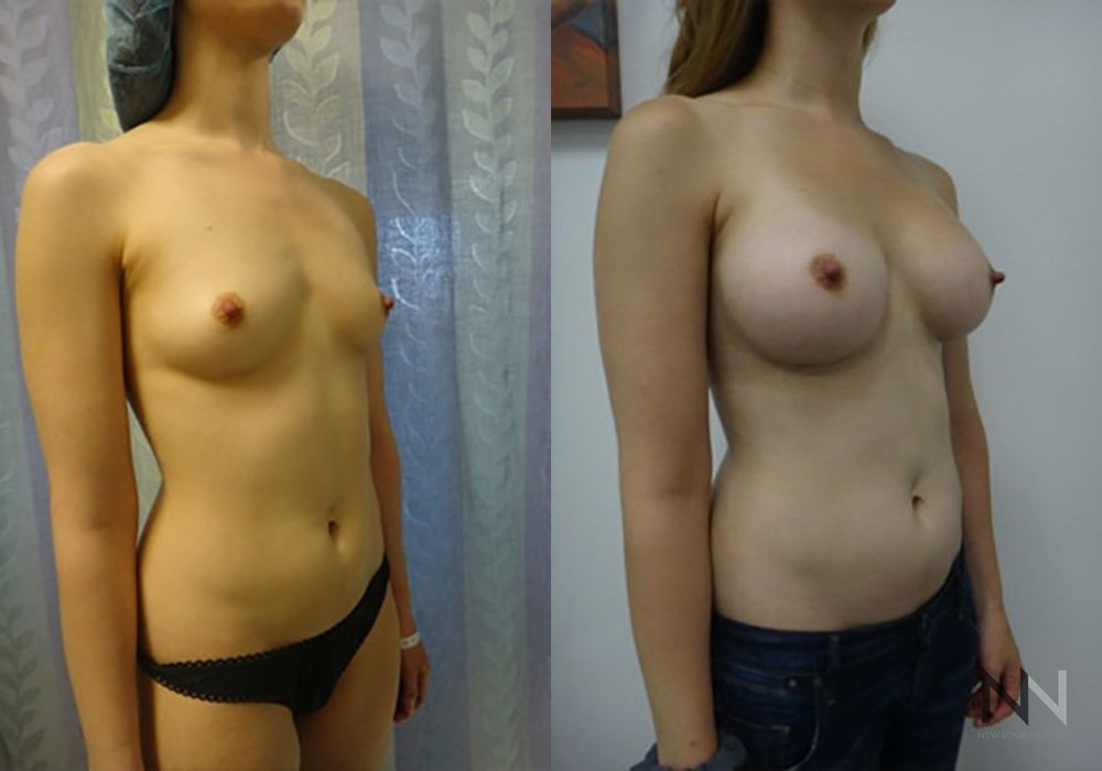 Breast Augmentation - Thumbnail 3