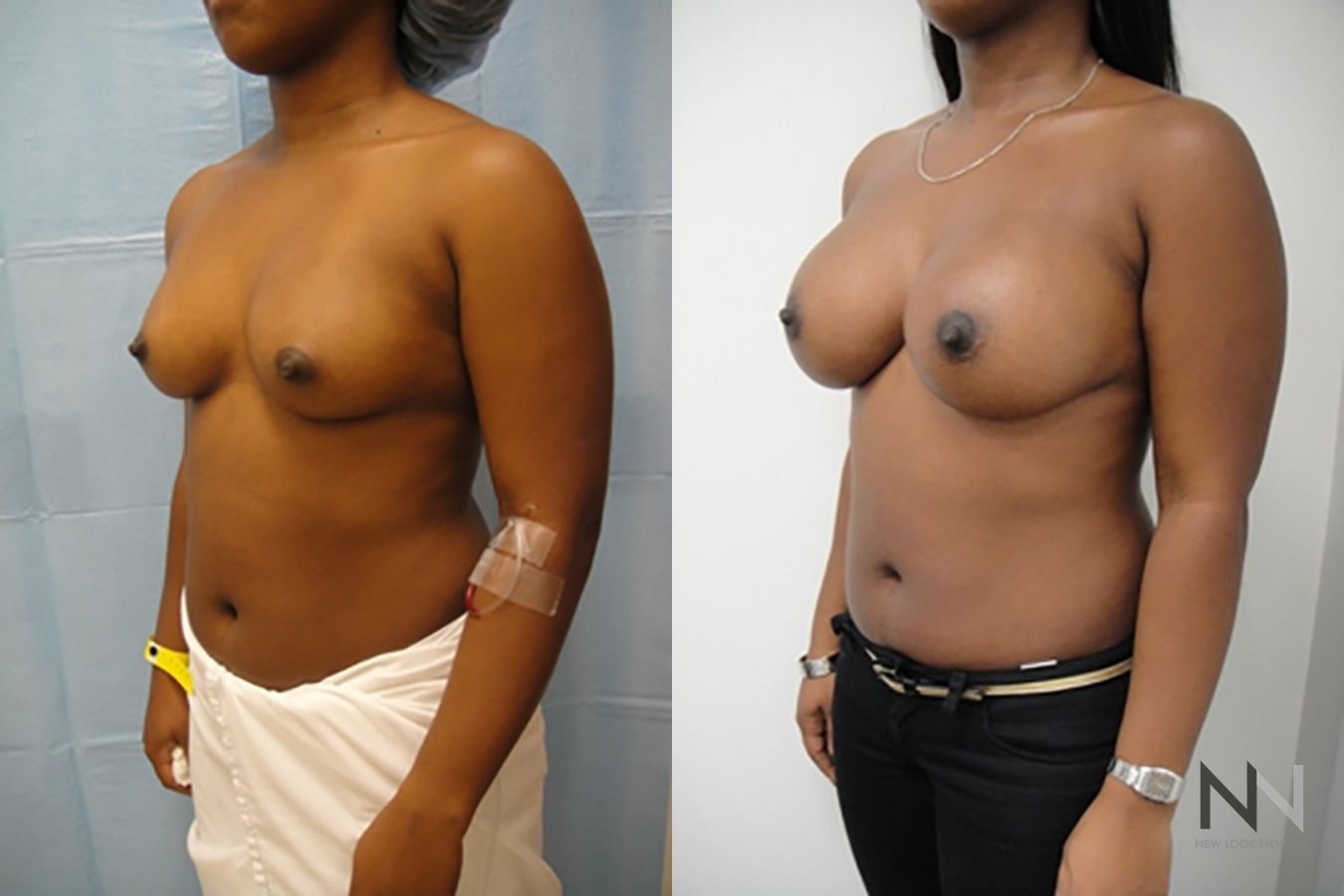 Before and after breast augmentation six months results - Angle 2