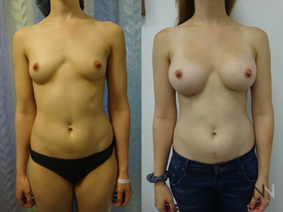 Before and after breast augmentation six months results