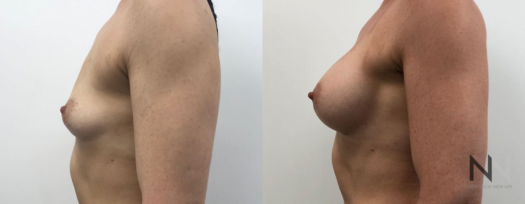 Breast Augmentation - Thumbnail 2