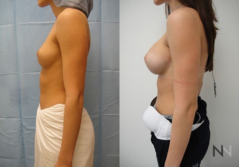 Breast Augmentation - Thumbnail 4