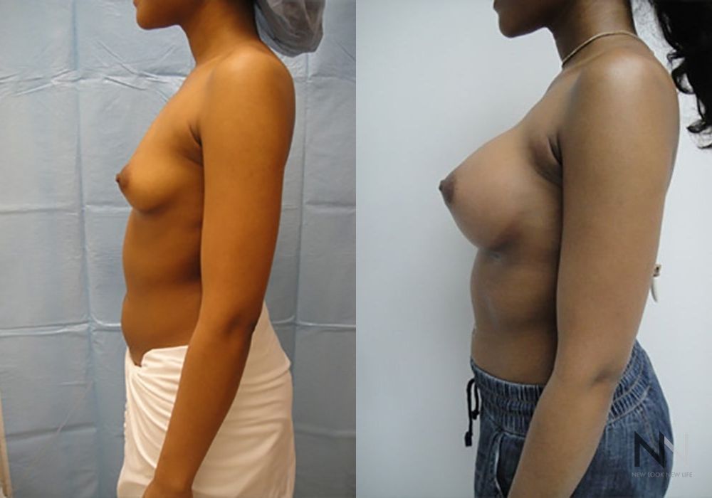 Breast Augmentation - Thumbnail 3