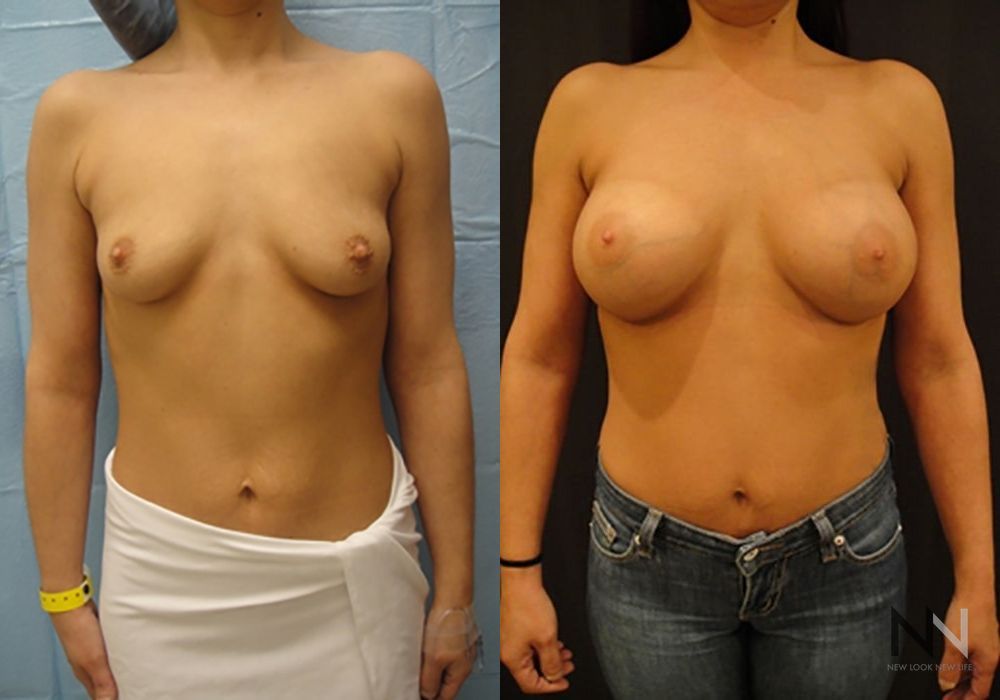 Breast Augmentation - Case 1998