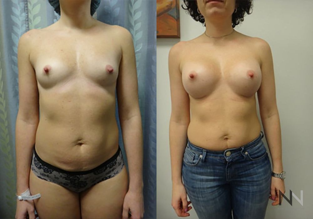 Breast Augmentation - Case 1997