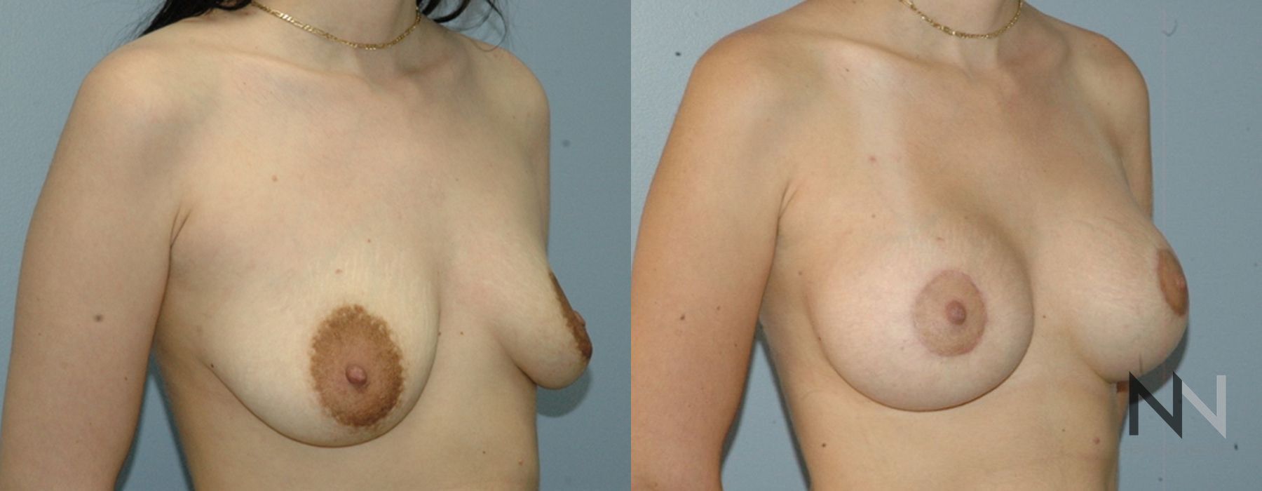 Breast Augmentation - Thumbnail 2